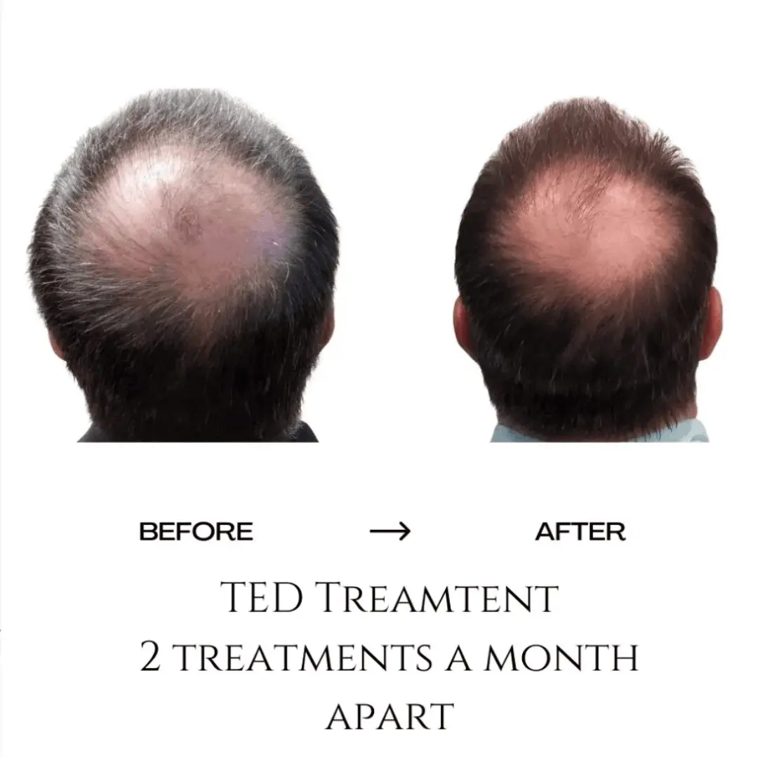TED Treatment 2 treatments a month apart - change in hair