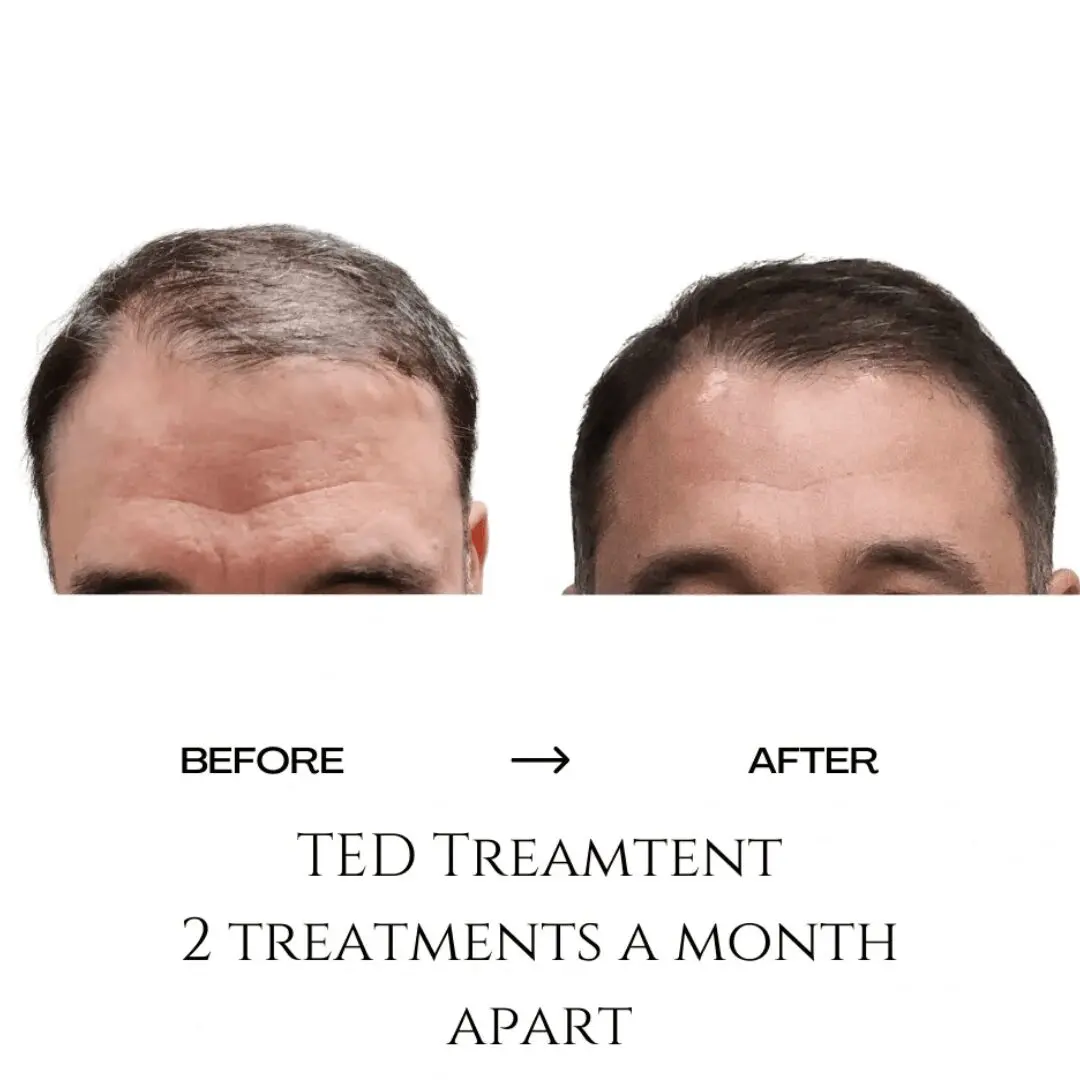 Hair growth of the client after 2 treatments