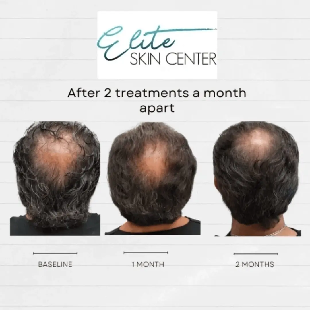 Continuous hair growth of the client after 2 treatments