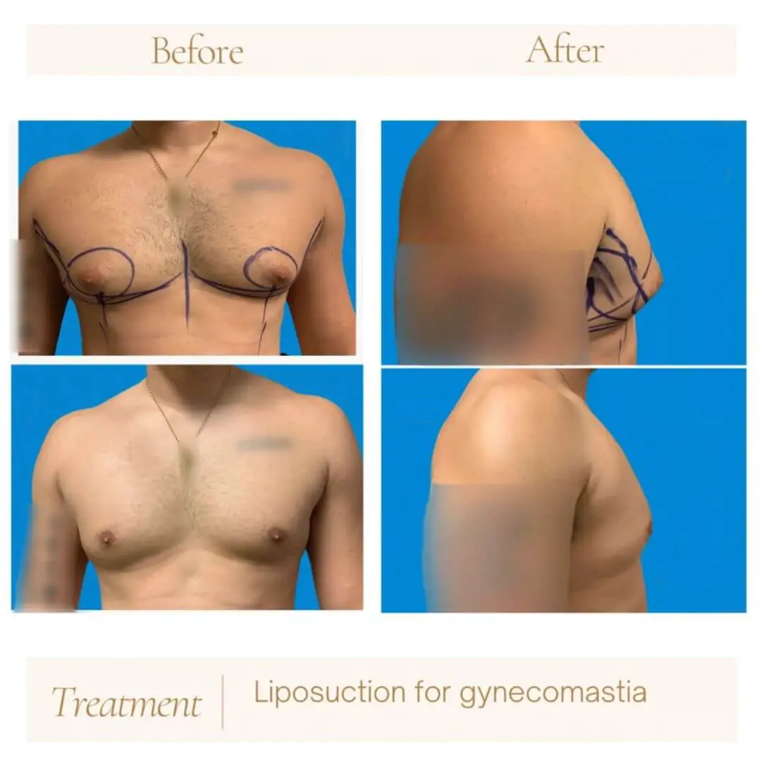 Liposuction for gynecomastia