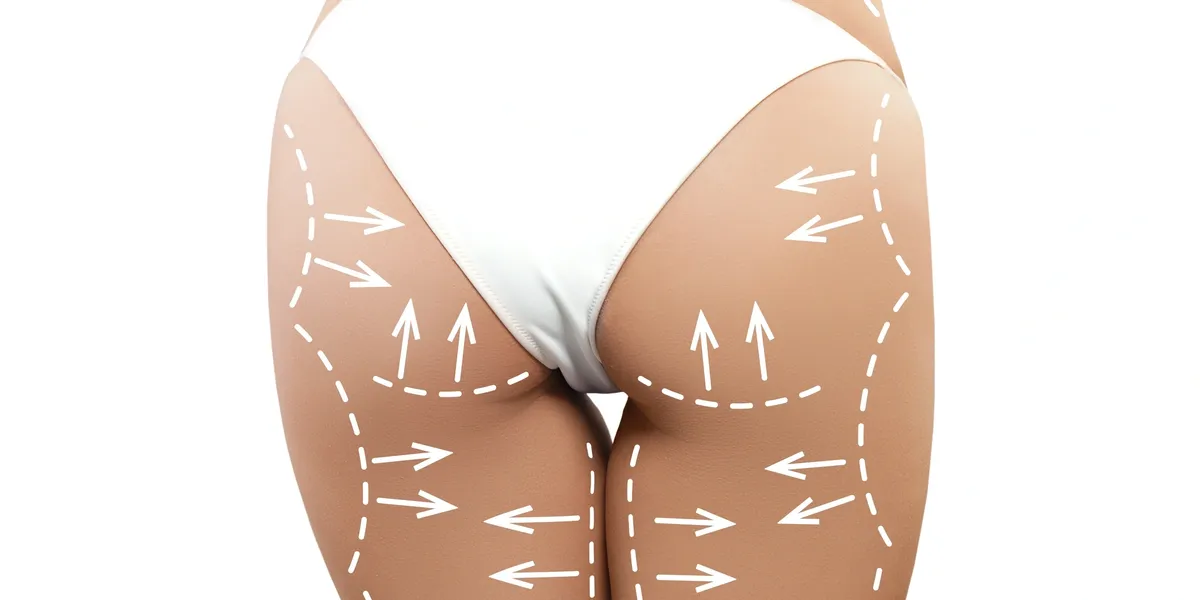 A woman 's buttocks with lines drawn on them.