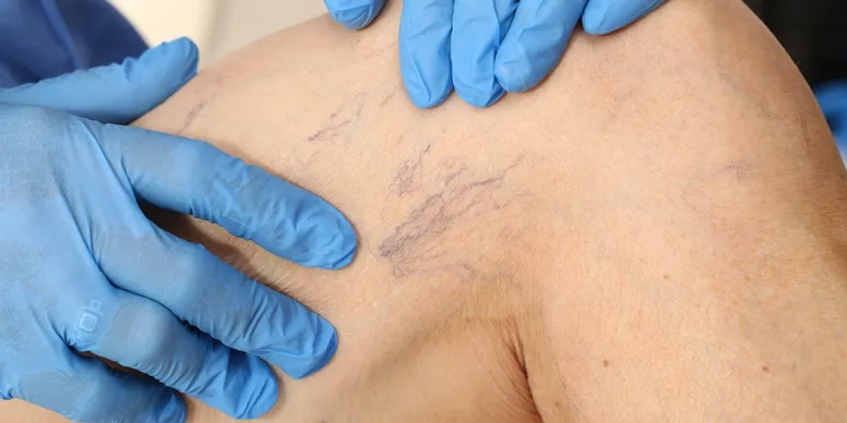 Removal of varicose veins on the legs. Medical inspection and treatment of Telangiectasia.