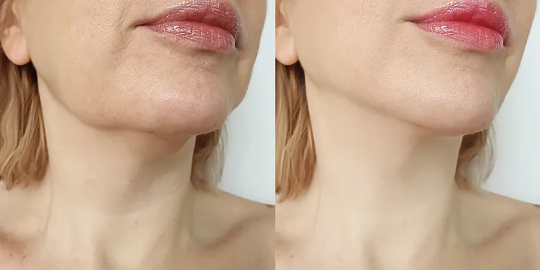 Woman face lift before and after treatment