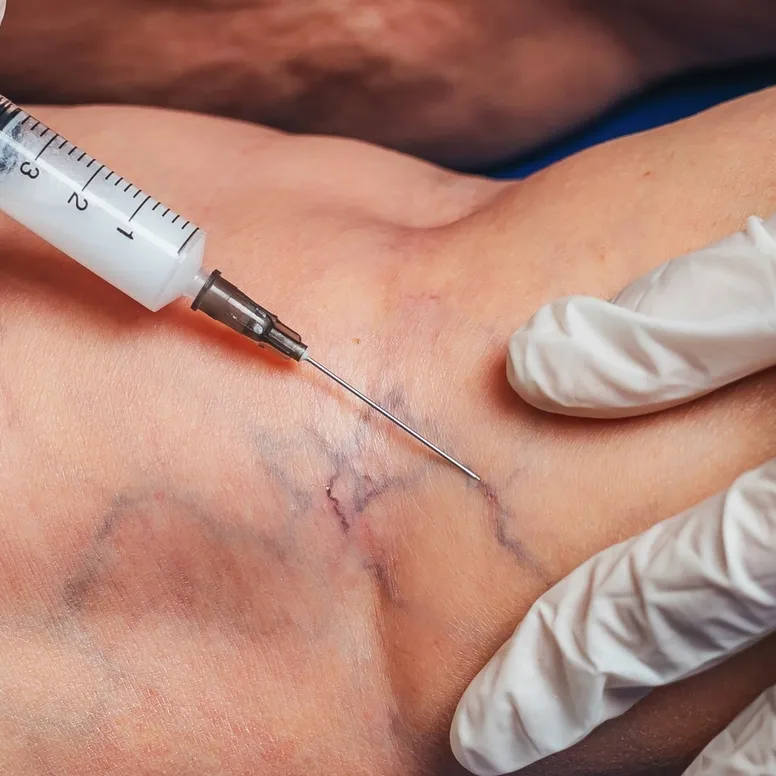 Syringe injection process in a vein close up